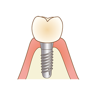 インプラント
